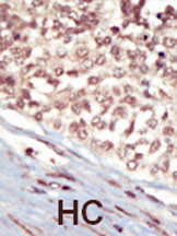 ab5398 staining Eph receptor A5 in human hepatocarcinoma (HC) tissue by Immunohistochemistry (Formalin/PFA-fixed paraffin-embedded sections).