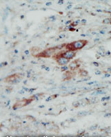 Human cancer tissue stained with ab5418 followed by peroxidase-conjugated secondary antibody and AEC.