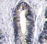 ab5425 staining Eph receptor B2 in human breast carcinoma (BC) tissue by Immunohistochemistry (Formalin/PFA-fixed paraffin-embedded sections).