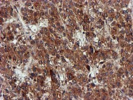 ab119303 at 1/150 dilution staining EPM2AIP1 in Paraffin-embedded Human Liver carcinoma tissue by Immunohistochemistry.