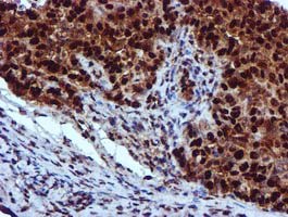 ab119303 at 1/150 dilution staining EPM2AIP1 in Paraffin-embedded Human Ovary adenocarcinoma tissue by Immunohistochemistry.