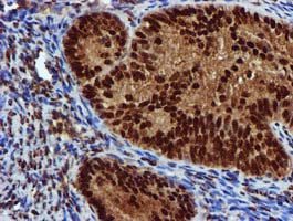 ab119303 at 1/150 dilution staining EPM2AIP1 in Paraffin-embedded Human Endometrium adenocarcinoma tissue by Immunohistochemistry.
