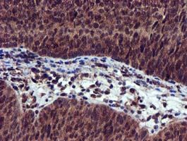 ab119303 at 1/150 dilution staining EPM2AIP1 in Paraffin-embedded Human bladder carcinoma tissue by Immunohistochemistry.