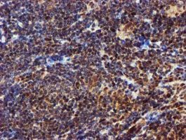 ab119303 at 1/150 dilution staining EPM2AIP1 in Paraffin-embedded Human Lymphoma tissue by Immunohistochemistry.