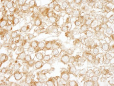 ab84810, at 1/500 dilution, staining EPS15 in formalin-fixed, paraffin-embedded human testicular seminoma by Immunohistochemistry using DAB staining.