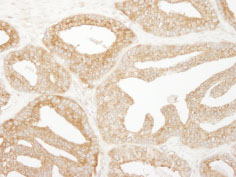 ab84810, at 1/500 dilution, staining EPS15 in formalin-fixed, paraffin-embedded human prostate carcinoma by Immunohistochemistry using DAB staining.