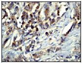 ab53006, at a 1/50 dilution, staining Human EPS15R in Breast Carcinoma, using Immunohistochemsitry, Paraffin embedded tissue.