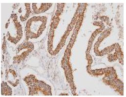 Immunohistochemical analysis of paraffin embedded OVCA xenograft tissue, labelling ERAB using ab137455 at 1/100 dilution.