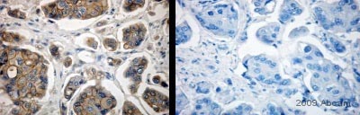 ab2428 staining ErbB 2 in human breast cancer, tissue section by Immunohistochemistry (Formalin/PFA-fixed paraffin-embedded sections). Tissue underwent fixation in formaldehyde, heat mediated antigen retrieval in Citrate buffer pH 6.0 and blocking in 10% serum for 1 hour at 20°C.The primary antibody was diluted, 1/100 in TBS and incubated with sample for 12 hours at 4°C. A Biotin conjugated goat polyclonal to rabbit IgG was used undiluted, as secondary. Left hand-side image show staining with ab2428 and developed using DAB detection system while right hand-side shows Isotype control staining with anti-rabbit IgG and DAB.See Abreview