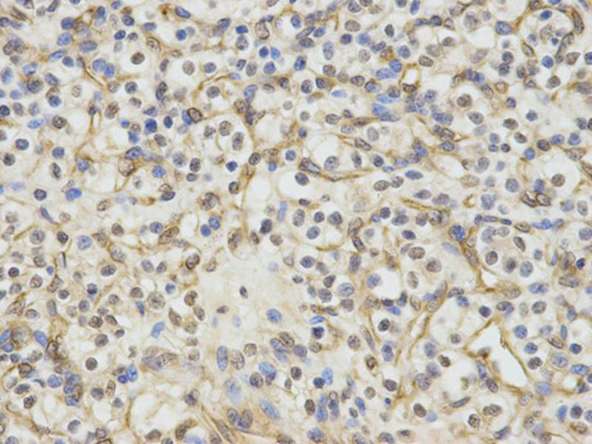 Immunohistochemical analysis of paraffin-embedded Human kidney cancer tissue labeling ERCC1 with ab196869 at 1/50.