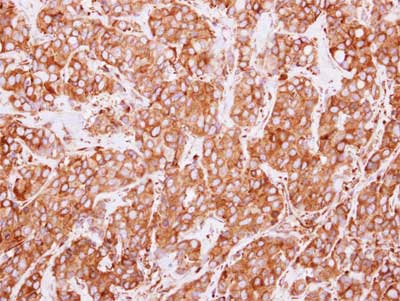 Immunohistochemical analysis of paraffin-embedded Human Breast carcinoma tissue labeling ERp72with ab155800 at 1/500 dilution.