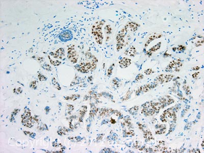 IHC image of Estrogen Receptor alpha staining in Human breast Ductal carcinoma formalin fixed paraffin embedded tissue section, performed on a Leica BondTM system using the standard protocol F. The section was pre-treated using heat mediated antigen retrieval with sodium citrate buffer (pH6, epitope retrieval solution 1) for 20 mins. The section was then incubated with ab3575, 5µg/ml, for 15 mins at room temperature and detected using an HRP conjugated compact polymer system. DAB was used as the chromogen. The section was then counterstained with haematoxylin and mounted with DPX.For other IHC staining systems (automated and non-automated) customers should optimize variable parameters such as antigen retrieval conditions, primary antibody concentration and antibody incubation times.