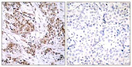 Immunohistochemical analysis of paraffin-embedded Human breast carcinoma tissue labelling Estrogen Receptor alpha with ab131437 at 1/50 dilution. Right panel was preincubated with blocking peptide.