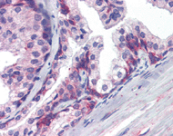 ab111086, at 3.75µg/ml, staining Estrogen Receptor beta in formalin-fixed, paraffin-embedded Human Prostate tissue by Immunohistochemistry.