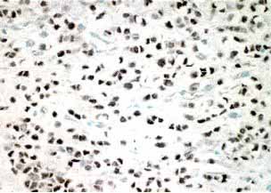 ab288 staining infiltrating lobular carcinoma of the breast by IHC-P.