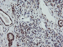 Immunohistochemical analysis of paraffin embedded Human kidney carcinoma tissue labelling Estrogen Related Receptor gamma with ab131593 at 1/150 dilution.