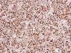 Immunohistochemical analysis of paraffin-embedded Human MCF7 xenograft tissue labeling ETFA with ab153722 at 1/250 dilution.