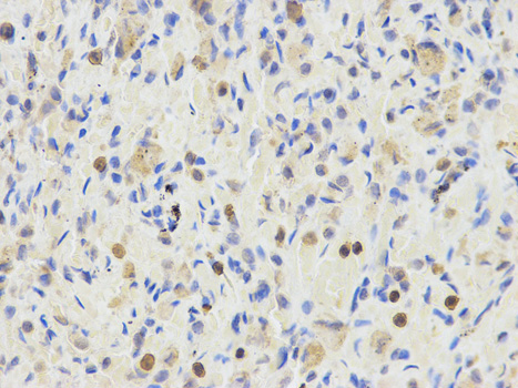 Immunohistochemistry (Formalin/PFA-fixed paraffin-embedded sections) analysis of human lung tissue labelling ETV6 / Tel with ab185816 at 1/200. Magnification: 400x.