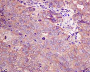 Immunohistochemical analysis of paraffin embedded Human Endometrial carcinoma tissue using ab151546 showing +ve staining.