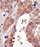 Formalin-fixed, paraffin-embedded human hepatocarcinoma tissue reacted with ab70937 at a 1:50 dilution, which was peroxidase-conjugated to the secondary antibody, followed by DAB staining.