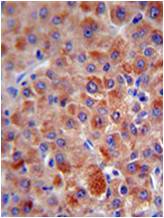 ab106974 at 1/50 dilution staining Factor H in Human hepatocarcinoma by Immunohistochemistry Formalin-fixed, Paraffin-embedded tissue. Detection: DAB staining