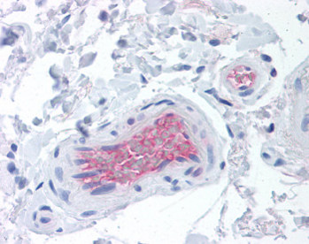 ab115312 at 20ug/ml staining Factor I in Human colon (vessels) tissue by immunohistochemistry (FFPE). After primary incubation, slides were incubated with biotinylated anti-mouse IgG secondary antibody, alkaline phosphatase-streptavidin and chromogen.