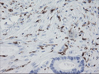 Immunohistochemical analysis of paraffin-embedded Human colon adenocarcinoma tissue labelling Factor XIII/XIIIa with ab131646 at 1/150 dilution.