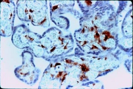 ab1834 - immunohistochemistry Formalin fixed paraffin embedded human placenta stained with Factor XIIIa, using ABC and AEC chromogen.