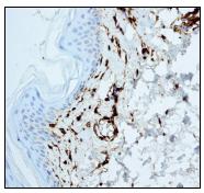 ab76105, at 1/100 dilution, staining Factor XIIIa in paraffin-embedded human skin tissue by Immunohistochemistry. Note positive staining of dendrocytes within the papillary dermis.