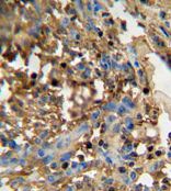 ab107079, at a 1/50 dilution, staining FAM20C in formalin fixed, paraffin embedded Human breast carcinoma by Immunohistochemistry, followed by peroxidase conjugation of the secondary antibody and DAB staining.
