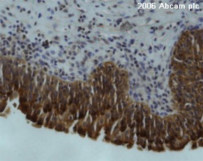 ab2437 at a 1/10 dilution staining human urothelium (bladder cancer) tissue sections by IHC (Formalin-fixed paraffin-embedded sections). Following heat mediated antigen retrieval the tissue was paraformaldehyde fixed and then incubated with the primary antibody for 30 minutes. An HRP conjugated goat antibody was used as the secondary.See Abreview