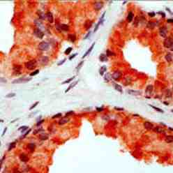 Formalin fixed paraffin embedded human prostate stained with Fas Ligand using ABC and AEC chromogen.