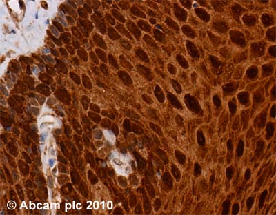 ab37267 (1µg/ml) staining Fatty Acid Binding Protein 5 in human oesophagus using an automated system (DAKO Autostainer Plus). Using this protocol there is strong staining of the cytoplasm and nuclei in stratified squamous epithelium cells.Sections were rehydrated and antigen retrieved with the Dako 3 in 1 AR buffers EDTA pH 9.0 in a DAKO PT link. Slides were peroxidase blocked in 3% H2O2 in methanol for 10 mins. They were then blocked with Dako Protein block for 10 minutes (containing casein 0.25% in PBS) then incubated with primary antibody for 20 min and detected with Dako envision flex amplification kit for 30 minutes. Colorimetric detection was completed with Diaminobenzidine for 5 minutes. Slides were counterstained with Haematoxylin and coverslipped under DePeX. Please note that, for manual staining, optimization of primary antibody concentration and incubation time is recommended. Signal amplification may be required.