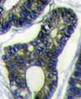 ab63065 at 1/50 - 1/100 dilution, staining FAU in human colon carcinoma by Immunohistochemistry, Formalin-fixed, Paraffin-embedded tissue, followed by peroxidase-conjugated secondary antibody and DAB staining.