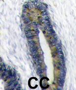 Ab63066 (1/50-1/100) staining human FAU in human colon carcinoma tissue by immunohistochemistry using formalin fixed, paraffin embedded tissue. Ab63066 was peroxidase-conjugated to the secondary antibody, followed by DAB staining.