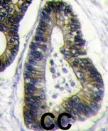 Ab63063 (1/50-1/100) staining human FAU in human colon carcinoma tissue by immunohistochemistry using formalin fixed, paraffin embedded tissue. Ab63063 was peroxidase-conjugated to the secondary antibody, followed by DAB staining.