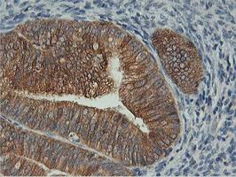 ab119374 at 1/150 dilution staining FDFT1 in Paraffin-embedded Human endometrium adenocarcinoma tissue by Immunohistochemistry.
