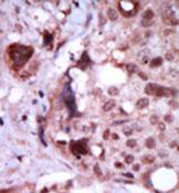 Formalin fixed and paraffin embedded human breast carcinoma tissue reacted with 1/50 ab71681. A peroxidase conjugated secondary antibody was used, followed by DAB staining.
