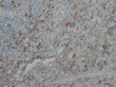 ab65974 at 1µg/ml staining FGF4 in human lung cancer tissue sections.