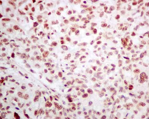 ab166630 showing +ve staining in Human melanoma.