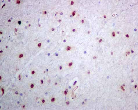 ab166630 showing +ve staining in Human glioma.