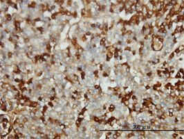 Fibrinogen antibody (ab58207) used in immunohistochemistry at 1ug/ml on formalin fixed and paraffin embedded human hepatocellular carcinoma tissue.