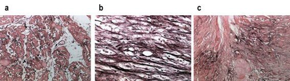 Ab6328 positively staining paraffin fixed canine myocardial infarct. tissue (1/200). The images demonstrate the time course of fibronectin deposition in reperfused canine myocaridal infarcts.  a: 24 hrs  b: 7 days  c: 28 days of reperfusion.  Secondary: Biotin conjugated goat anti mouse (5 µg/ml). Detection was achieved using DAB.  This image is an edited version of an image submitted courtesy of an Abreview by Marcin Dobaczewski. We do not have any further information relating to this image.See Abreview