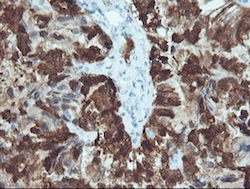 ab128100, at 1/150 dilution, staining CRABP2 in paraffin-embedded Adenocarcinoma of Human ovary by Immunohistochemistry.