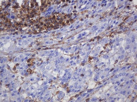 Immunohistochemical analysis of paraffin embedded Human liver carcinoma tissue labelling FNDC4 with ab140381 at a 1/150 dilution.