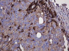 Immunohistochemical analysis of paraffin embedded Human ovary adenocarcinoma tissue labelling FNDC4 with ab140381 at a 1/150 dilution.