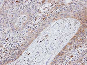 Immunohistochemical analysis of paraffin-embedded Human lung carcinoma tissue labelling Folate Binding Protein with ab137347 at 1/100 dilution.
