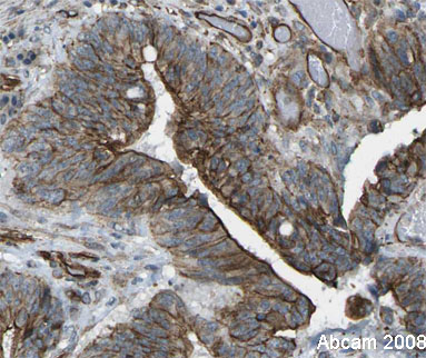 Image courtesy of Human Protein Atlas ab18196 staining in human rectum with colo-rectal cancer, showing staining of the tumour cells (in brown). Paraffin embedded rectal tissue was incubated with ab18196 (1:1000 dilution) for 30 mins at room temperature. Antigen retrieval was performed by heat induction in citrate buffer pH 6. ab18196 was tested in a tissue microarray (TMA) containing a wide range of normal and cancer tissues as well as a cell microarray consisting of a range of commonly used, well characterised human cell lines. Further results for this antibody can be found at www.proteinatlas.org.