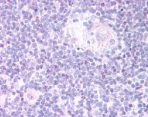 Ab26069 (20ug/ml) staining human FOXN1 in human thymus medulla tissue by immunohistochemistry using paraffin embedded tissue. Steamed antigen retrieval with citrate buffer pH 6, AP-staining. In paraffin embedded Human Thymus Medulla shows speculate nuclear staining in some of the Medullar cells.
