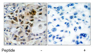 Immunohistochemical analysis of paraffin-embedded human lung carcinoma tissue using ab47396 at a 1/50 dilution. Left image : Un-treated Right image : Treated with peptide